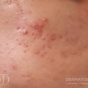 JDD Case3 Picture 3A hyperpigmentation 22_5