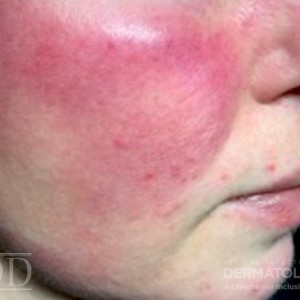 JDD C7237 Figure 1B Rosacea 22_6