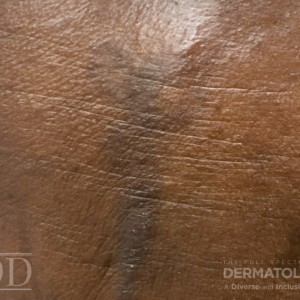 JDD C7200 Figure 1 22_1 hyperpigmentation closeup