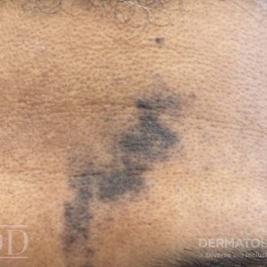 JDD C7200 Figure 2 hyperpigmentation 22_1