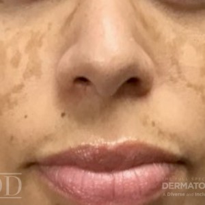 JDD M6663 Figure 2 Melasma 21_4