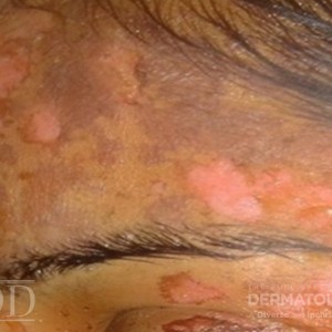 JDD M6485 Figure 3_b hyperpigmentation 21_3 !