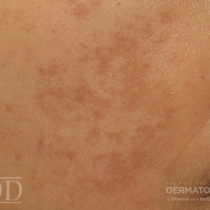 JDD M6491 Figure 1 melasma 21_12_1