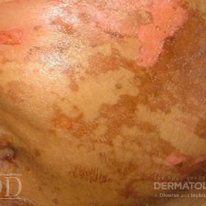 JDD M6485 Figure 3 b hyperpigmentation 21_3