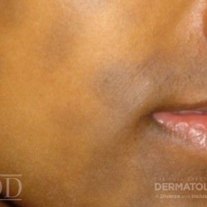 JDD M6485 Figure 5 a hyperpigmentation 21_3