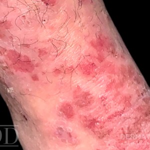 JDD C6271 Figure_1 pustular psoriasis 21_3