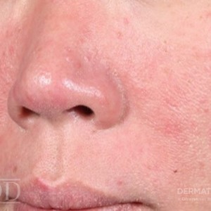 JDD M7021 Erythematotelangiectatic rosacea 22_1