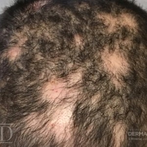 JDD M7161 Figure 2 alopecia areata 22_3