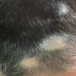 JDD M7161 Figure 1 alopecia A 22_3