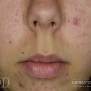 JDD M6778 Figure 2 acne 21_6 2