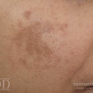 JDD M6687 Figure 2 Hyperpigmentation 21_4_2