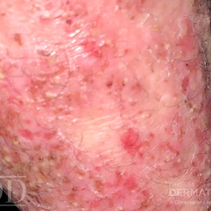 JDD C6271 Figure 1 pustular psoriasis 21_3 closeup