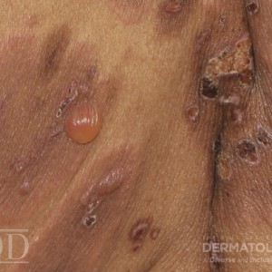 JDD C6690 Figures 1-3 Bullous Pemphigoid 21_8 closeup