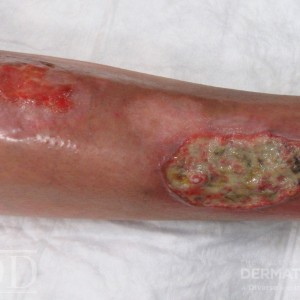 JDD C5566 Pyoderma Gangrenosum Figure 3 20_1