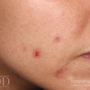 JDD M6876 Figure 4 acne 21_6_1