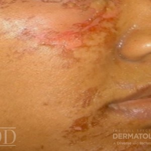 JDD M6485 Figure 3 a hyperpigmentation 21_3f