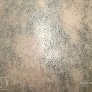 JDD M7161 Figure 4 Alopecia A 22_3