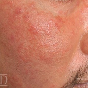 JDD M7021 Rosacea 22_1