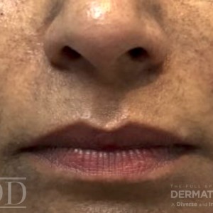 JDD C5521 Figure 1 Hyperpigmentation 22_1