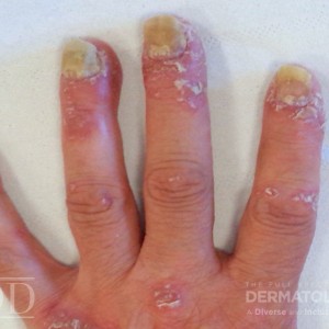 JDD L6828 Figure 2 Nail Psoriasis 21_8