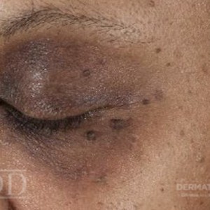 JDD M6687 Figure 2 Hyperpigmentation 21_4_4