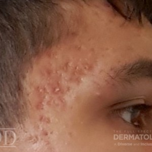 JDD Case3 Picture 3A hyperpigmentation 22_5 profile