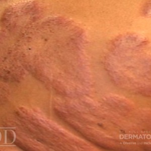 JDD M7008 Figure 2 cutaneous sarcoidosis 22_7 closeup