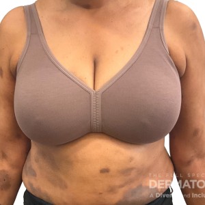 DermAtlas_Ctcl_GW_abdomen_full-anterior-09.18.2023-56567462