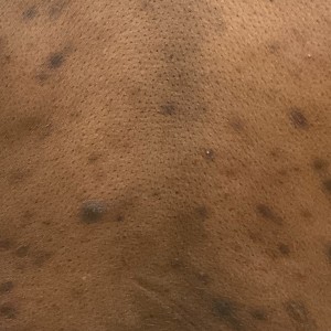 DermAtlas_Folliculitis_back_GW_3closeup