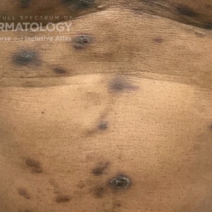 DermAtlas_Folliculitis_GW_1_lowerabdo