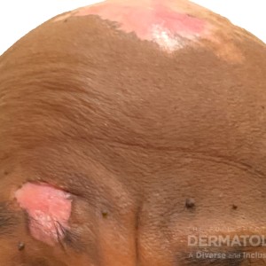 DermAtlas_Discoid lupus erythematosus_GW1_forehead