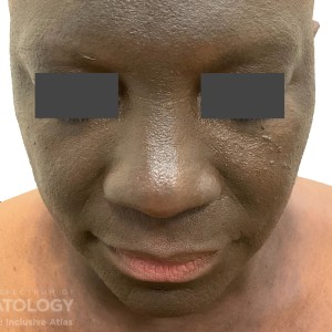 DermAtlas_facefull-Lichen_Planus_pigmentation R1