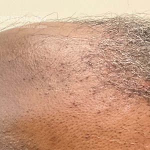 DermAtlas_frontal fibrosing alopecia_GW_3