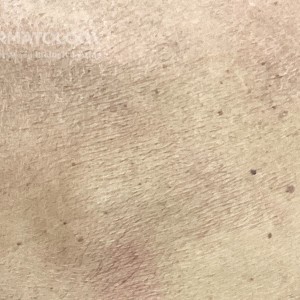 DermAtlas_Cutaneous T cell lymphoma _closeup-posterior-08.23.2023-55280156