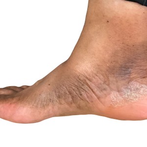 DermAtlas_Ctcl_GW_foot_lower-extremity-anterior-09.18.2023-56567526