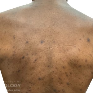 DermAtlas_Folliculitis_back_GW_3 R1b