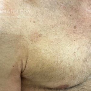 DermAtlas_Cutaneous T cell lymphoma upper-body-anterior-oblique-right-08.23.2023-55280063