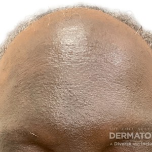 DermAtlas_1frontal fibrosing alopecia_GW_7