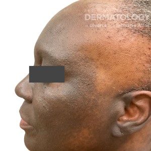 DermAtlas_Lichen planus pigmentosus and frontal fibrosing alopecia_GW_3