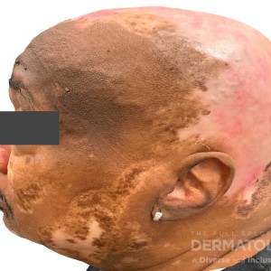 DermAtlas_Discoid lupus erythematosus_GW2_profile1