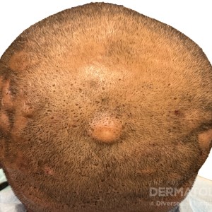 DermAtlas_Dissecting cellulitis_GW1