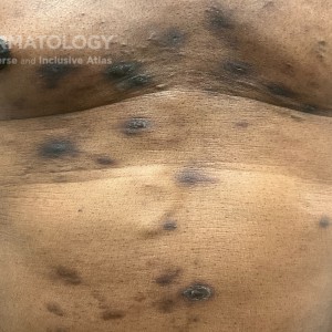 DermAtlas_Folliculitis_GW_2