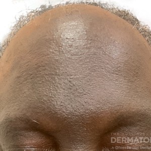 DermAtlas_forhead_Lichen planus pigmentosus and frontal fibrosing alopecia_GW_1b