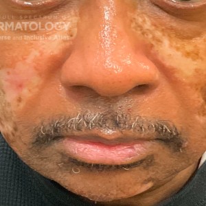 DermAtlas_Discoid lupus erythematosus_GW1_lower