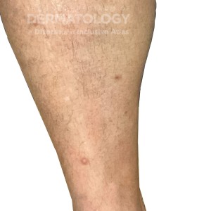 DermAtlas_dermatofibromas_1 copy