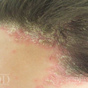 DermAtlas_JDD_M7531_Ped_Psoriasis_1