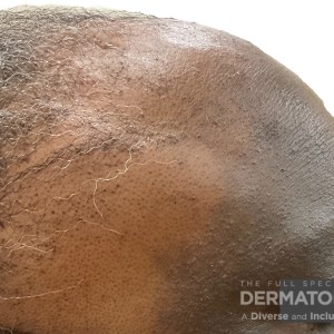 DermAtlas_closeup_Lichen planus pigmentosus and frontal fibrosing alopecia_GW-5