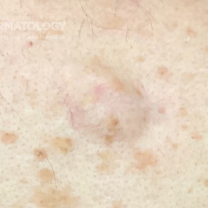 DermAtlas_Lipoma_GW_5