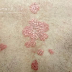 DermAtlas_Psoriasis vulgaris_full-body-male-posterior