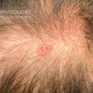 DermAtlas_Basal cell carcinoma_GW_1